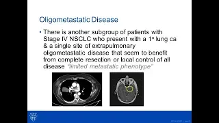 Blackmon Oligometastatic Lung Cancer Blackmon VATS RML 2017