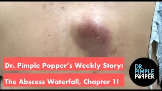 Dr. Pimple Popper Story Time: Abscess Waterfall, Ch 1