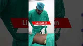 Six Pack Abs surgery | Six Pack Abs surgery Result | Liposuction cost #shortvideo #shots