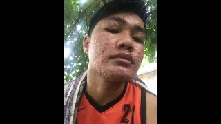 Big pimples sac dep spa - Loan nguyen large blackheads