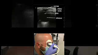 Ocular POCUS Demo #pocus