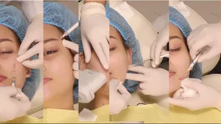 Full Face Non Surgical Procedure