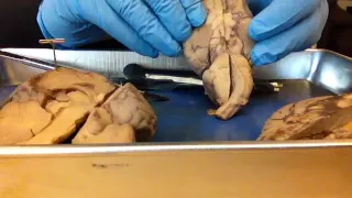 Brain Dissection