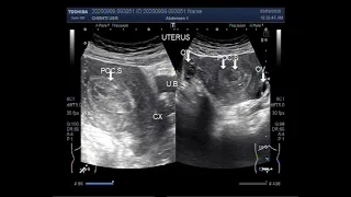 Ultrasound Video showing Retained products of conception (RPOC) after D & C.