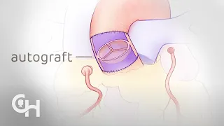 Ross Procedure for Damaged Aortic Valve in Children and Teens