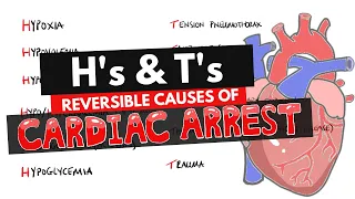 Reversible Causes of Cardiac Arrest Hs and Ts Mnemonic | H's & T's Mnemonic