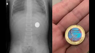 Gastric coin extraction in a 3-year-old child