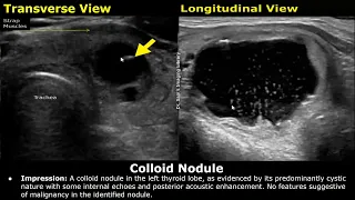 Thyroid Ultrasound Reporting | How To Write USG Scan Reports | Thyroid Pathologies | Small Parts USG