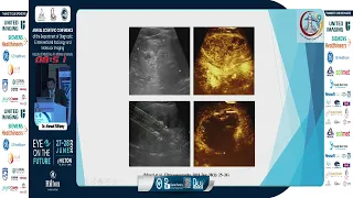 Laser Ablation of Thyroid Nodules