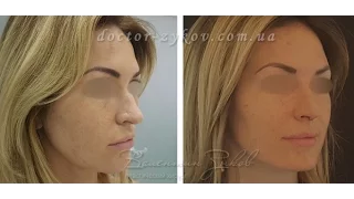 Open rhinoplasty  before and after | Dr. Zykov
