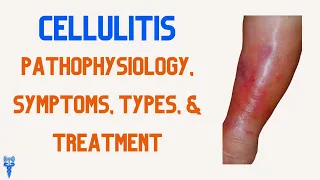CELLULITIS Pathophysiology, Types, Treatment, Symptoms, & Nursing Interventions