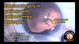 Cataract Surgery & Lattice Corneal Dystrophy