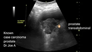 Carcinoma prostate: transabdominal and transrectal TRUS ultrasound video