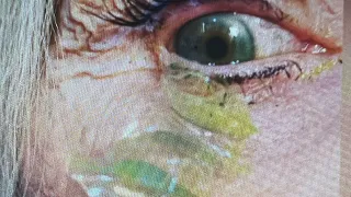 Woman had 23 contacts stuck in her eye as doctor removes them