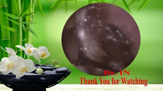 Satisfying Videos Earwax Removal With Dr. IN EARWAX #02 .