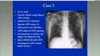 Tuberculosis Drug-Induced Liver Injury Webinar