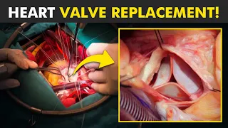 How Heart Valve Replacement Surgery Is Performed?