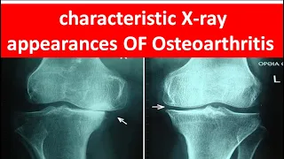 How to diagnose Osteoarthritis by xray