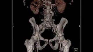 Vascular: Runoff study: 3D reconstructions demonstrate vascular map(2 of 2)