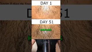 2.5 Months Minoxidil Regrowth Fails After 2.5 Years! #minoxidil #rogaine #hairloss