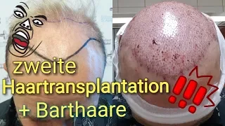 ZWEITE Haartransplantation Türkei vorher nachher/Barthaare auf Kopf transplantiert /Verdichtung😱