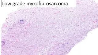 A guide to low grade myxoid sarcomas
