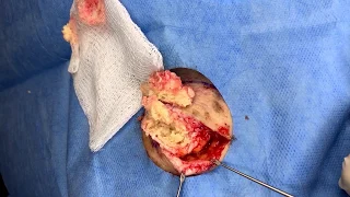Large Cyst Explodes On Doctor's Shoe
