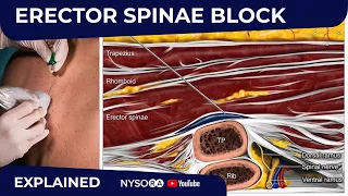 Erector Spinae Plane Block - Regional anesthesia Crash course with Dr. Hadzic