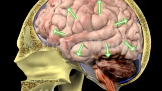 Brainstem herniation - Neuroanatomy