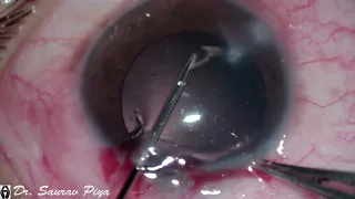 INTRACORNEAL FOREIGN BODY REMOVAL - Dr. Saurav Piya