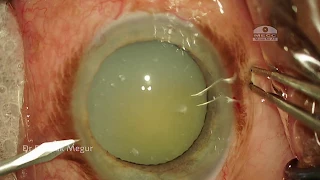 Phacoemulsification in an eye with Phacolytic Glaucoma & loose Zonules -  CTR  - Dr Deepak Megur