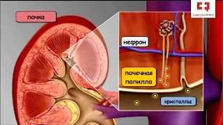 Камни в почках: виды камней, этапы формирования, факторы риска мочекаменной болезни и профилактика