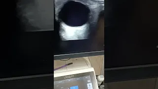 Optic Nerve Sheath Diameter for Raised ICP