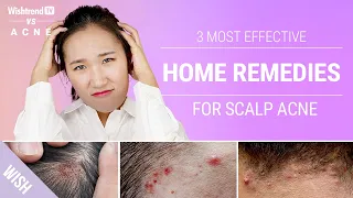 How to Get Rid of Scalp & Back of Neck Acne Naturally! | 3 Most Effective Home Remedies