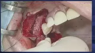 Prof. Daniel Buser: Early loading of implants placed with sinus floor elevation