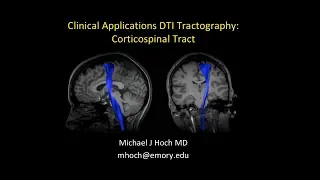 MRI Diffusion Tensor Imaging (DTI) interpretation - locating the corticospinal tract (CST)