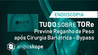 TUDO SOBRE TORe - Procedimento Endoscópico para Reganho de Peso após Bariátrica-Bypass - Angioskope