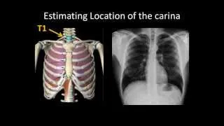 Basic Chest Radiology: ET Tube Position and Complications