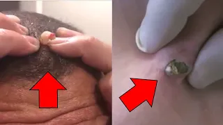 Pimple and blackhead popping - 1 Hour Christmas Special
