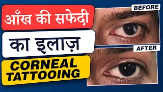 आँख में सफेदी का इलाज - Corneal Tattooing | Corneal Scar / Opacity Treatment by Corneal Tattooing