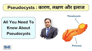 Pancreas pseudocyst : Endoscopy treatment  Causes, Symptoms, Treatment in Hindi, by Dr Vikas Singla