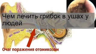 Чем лечить грибок в ушах у людей