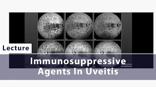 Immunosuppressive Agents In Uveitis