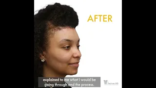 Forehead Reduction Testimonial | Dr. Frank Fechner