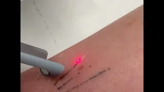 Видалення татуювання лазером надкороткого імпульсу Pico-Light Brilliant