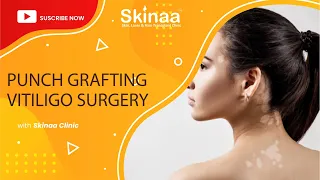 Punch Grafting Treatment for Vitiligo | Skinaa Clinic