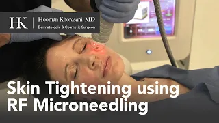 Skin Tightening of the Face using Radio-Frequency (RF) Microneedling by Dr. Hooman Khorasani