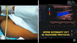 Upper Extremity DVT Ultrasound Protocol