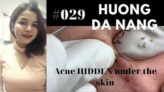 #029 |Acne HIDDEN under the skin | Acne treatment Hương Đà Nẵng Official