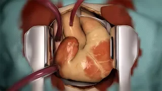 Heart Transplantation - a treatment for heart failure